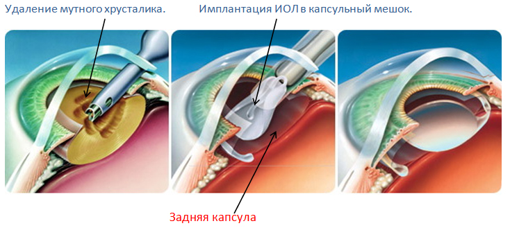 Удаление мутного хрусталика. Имплантация ИОЛ в капсульный мешок